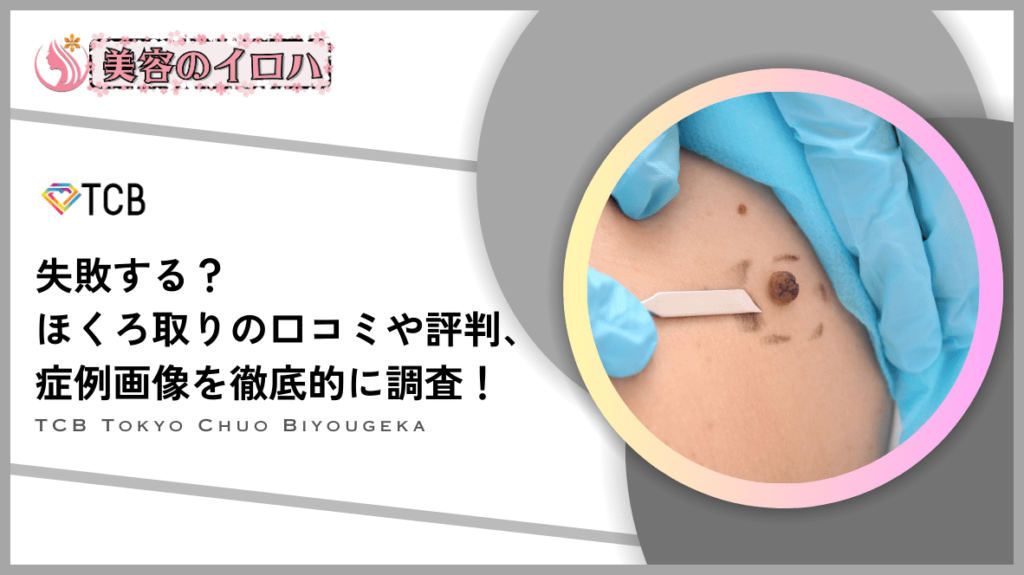 【やばい?】TCB東京美容外科のほくろ除去の口コミや評判を調査！安い料金でイボを取るのはやめた方がいいのか？