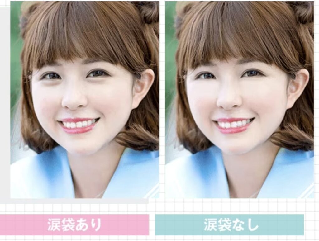 TCB東京中央美容外科で涙袋形成を受けるメリットと効果