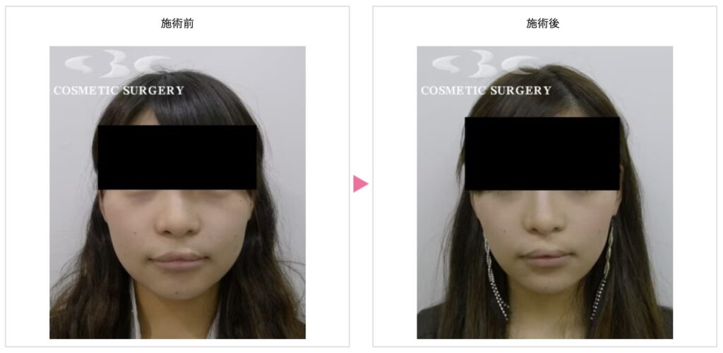 湘南美容クリニックで韓国製ボツリヌストキシン注射を受けた患者さんの実際の症例写真（ビフォーアフター）