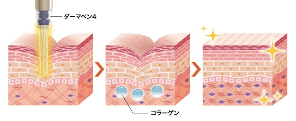 TCB東京中央美容外科のダーマペン4の効果と改善できる症状