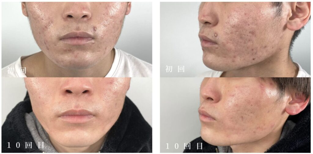 TCB東京中央美容外科のニキビ治療内服薬を実際に利用した方の症例画像（ビフォーアフター）