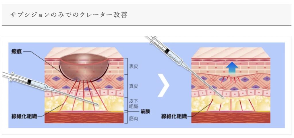 TCB東京中央美容外科のサブシジョンの効果と改善できるニキビの種類