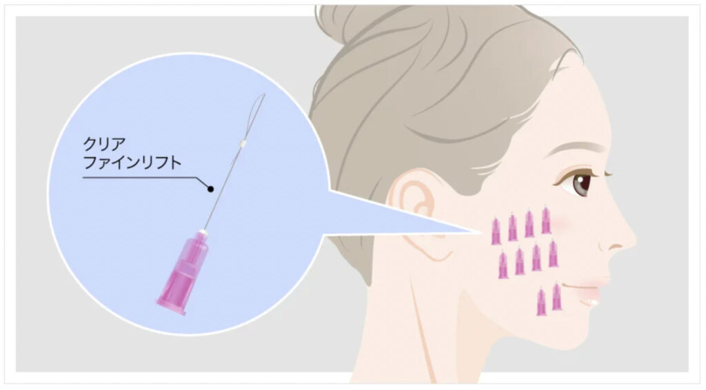 TCB東京中央美容外科のクリアファインリフトの効果と改善症状