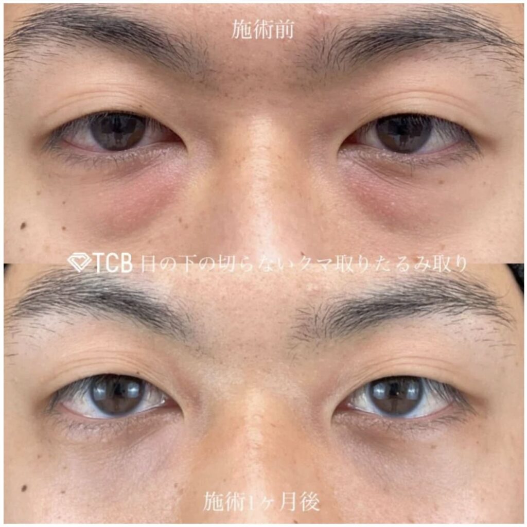 TCB東京中央美容外科で切らない目の下のクマ取り施術を受けた男性の症例写真（施術前と施術後）