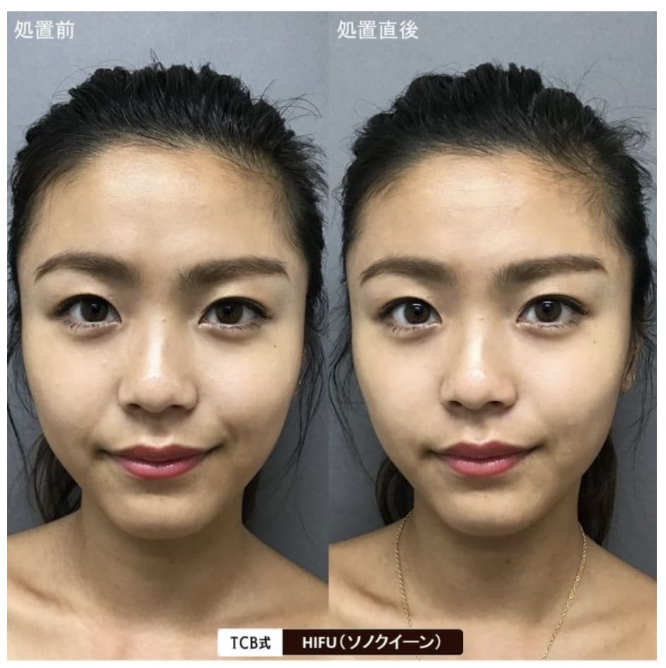 TCB東京中央美容外科 アイリフトHIFUの症例写真（ビフォーアフター）