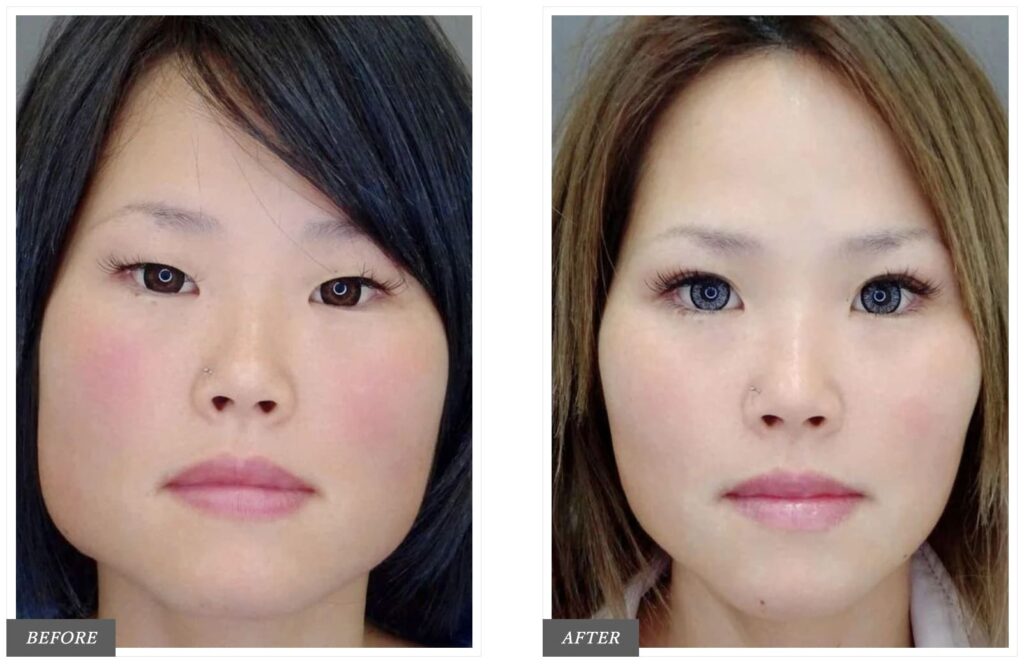 TCB東京中央美容外科で実際にエラボトックスを受けた方の症例写真
