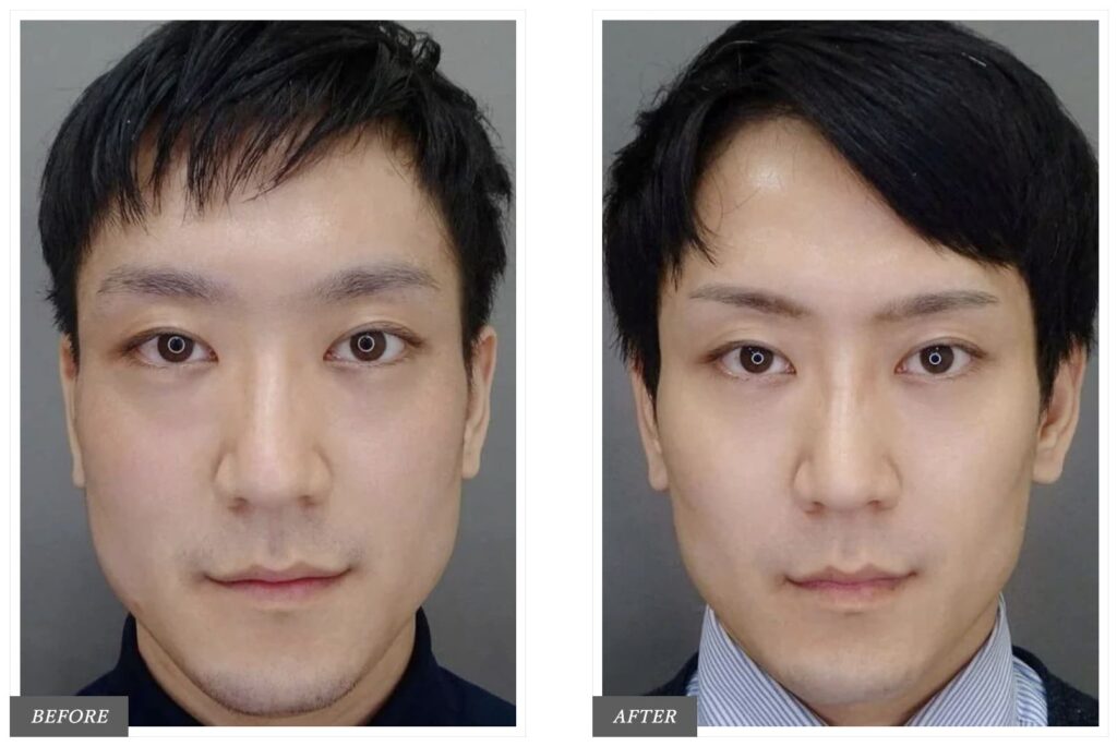TCB東京中央美容外科で実際にエラボトックスを受けた方のビフォーアフター症例写真（男性）
