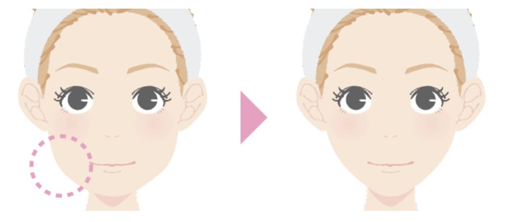 TCB東京中央美容外科のエラボトックスによる効果のイメージ