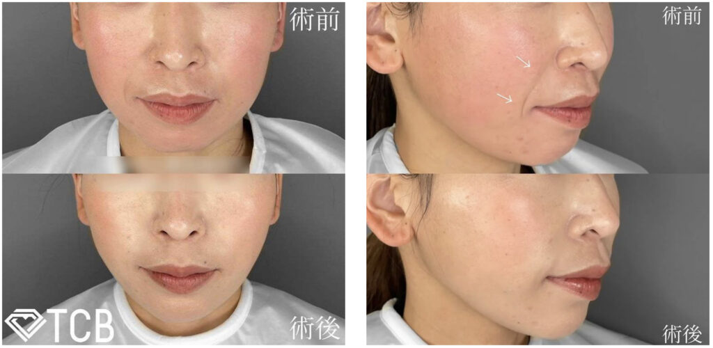 TCB東京中央美容外科の小顔リフトの症例写真（施術前・施術後）
