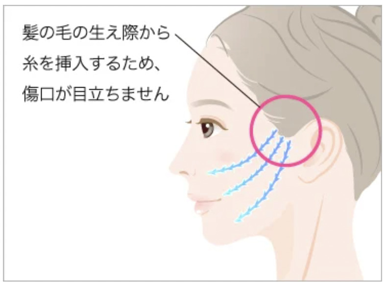 TCB東京中央美容外科の小顔美肌再生糸リフトの効果と改善できる症状