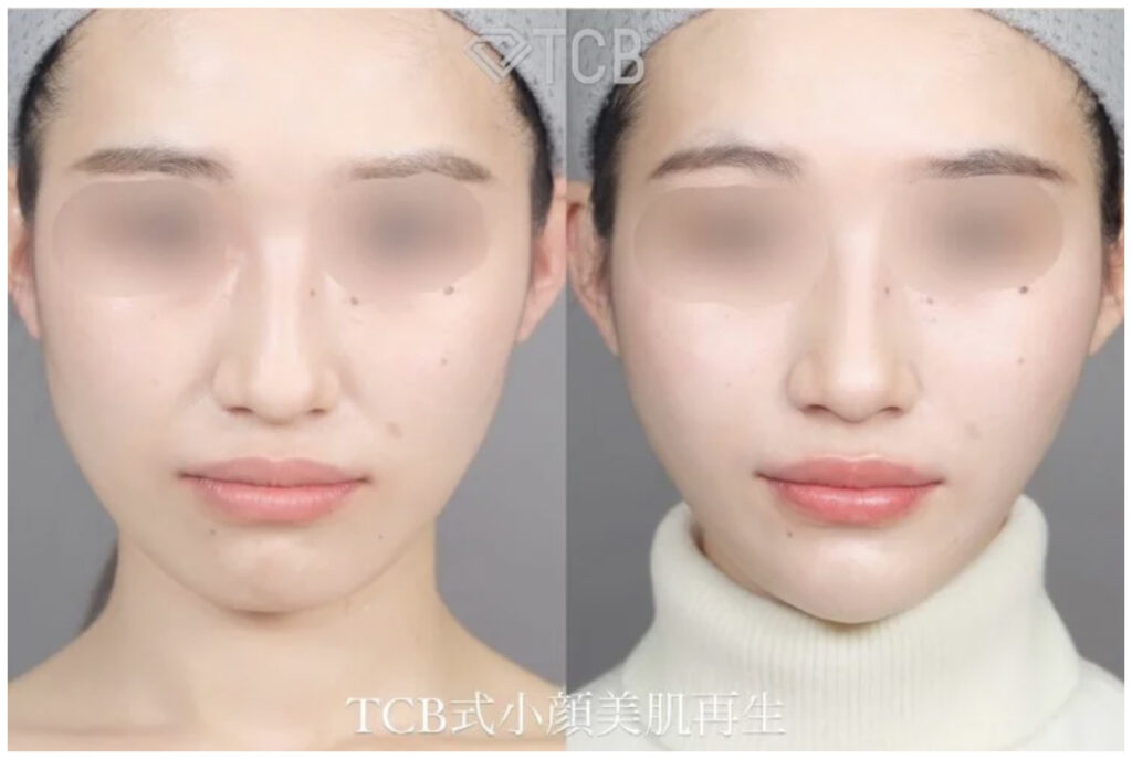 TCB東京中央美容外科の小顔美肌再生糸リフトの症例写真（施術前・施術後）