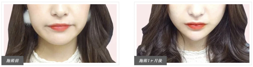 TCB東京中央美容外科 小顔美肌再生糸リフトの症例写真（施術前・施術後）