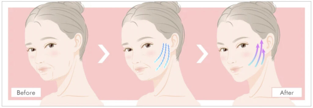 TCB東京中央美容外科の糸リフトで期待できる効果と改善できる症状