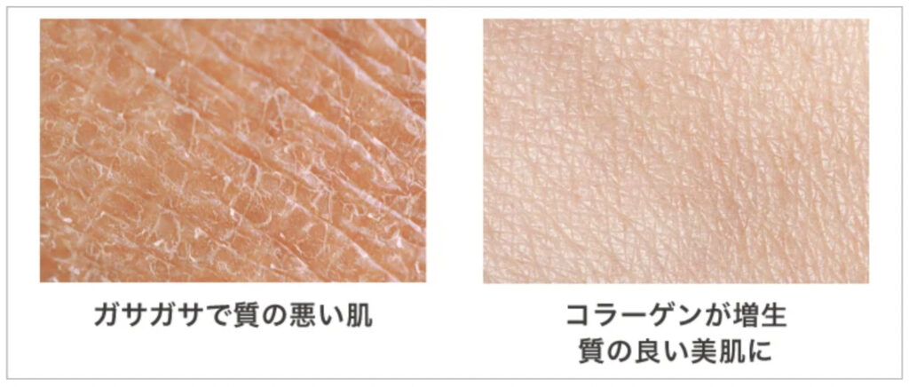 TCB東京中央美容外科の糸リフトによる美肌効果