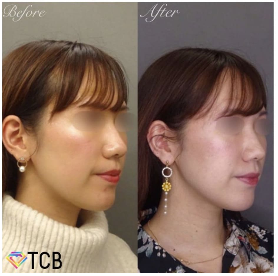TCB東京中央美容外科で実際にハイフ治療を受けた患者様の症例画像（ビフォー・アフター）
