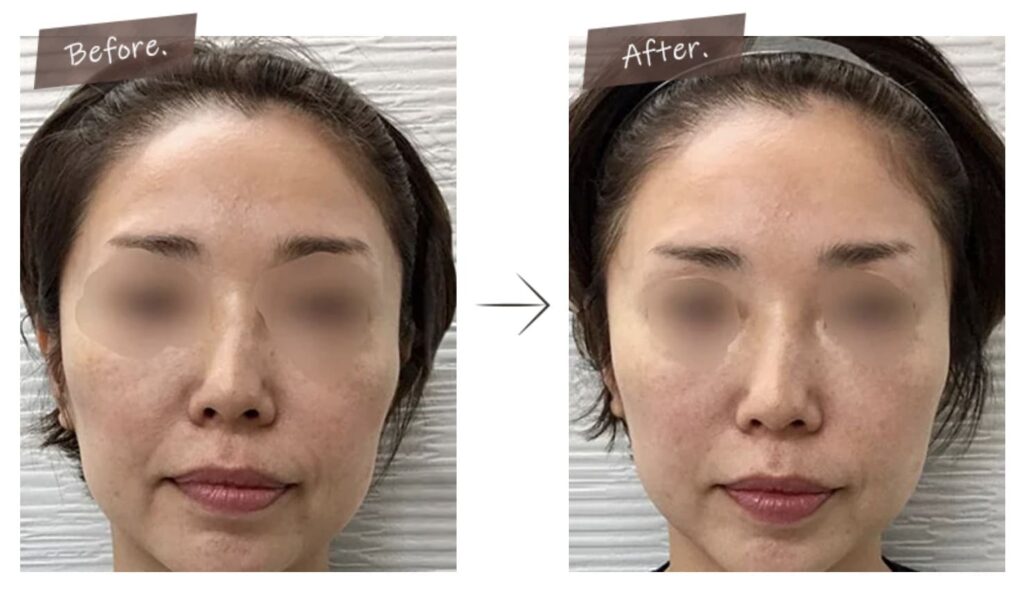 TCB東京中央美容外科で医療ハイフ「セレーネハイフ」を実際に受けられた患者様の症例画像（ビフォー・アフター）