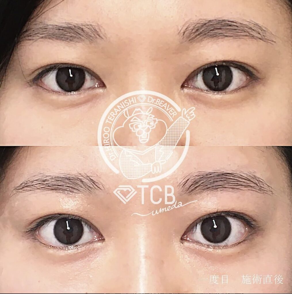 TCB東京中央美容外科 セレーネハイフの仕組みと効果 実際にアイリフトを受けた方の症例（ビフォー・アフター）