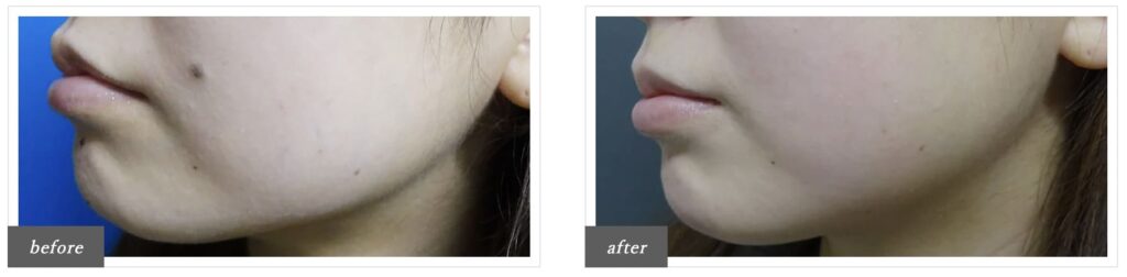 TCB東京中央美容外科で実際にほくろ除去を受けた方の症例画像（ビフォーアフター）