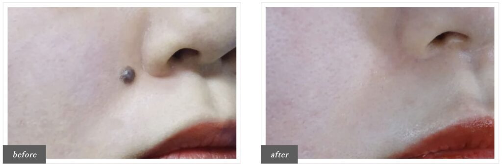 TCB東京中央美容外科で実際にほくろ除去を受けた方の症例画像（ビフォー・アフター）