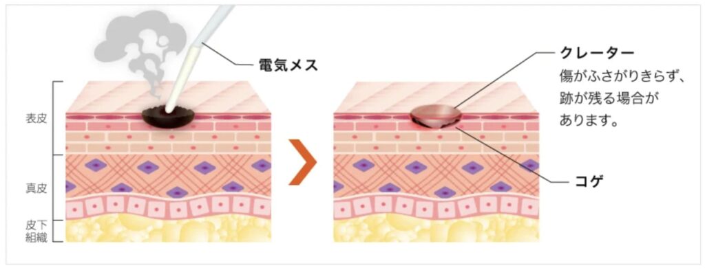 TCB東京中央美容外科での電気メスによるほくろ・いぼ除去