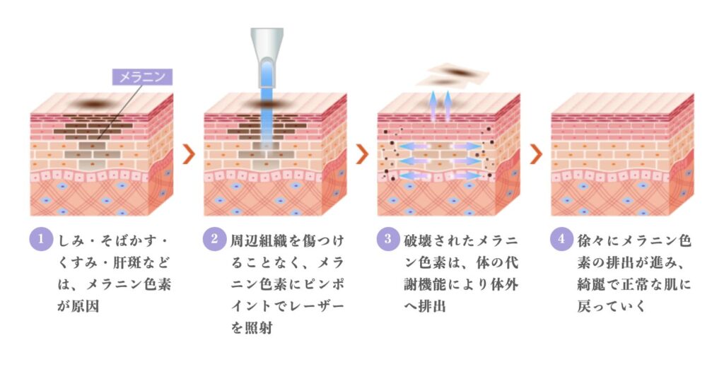 TCB東京中央美容外科のピコレーザーによるシミ除去の効果と治療の流れ