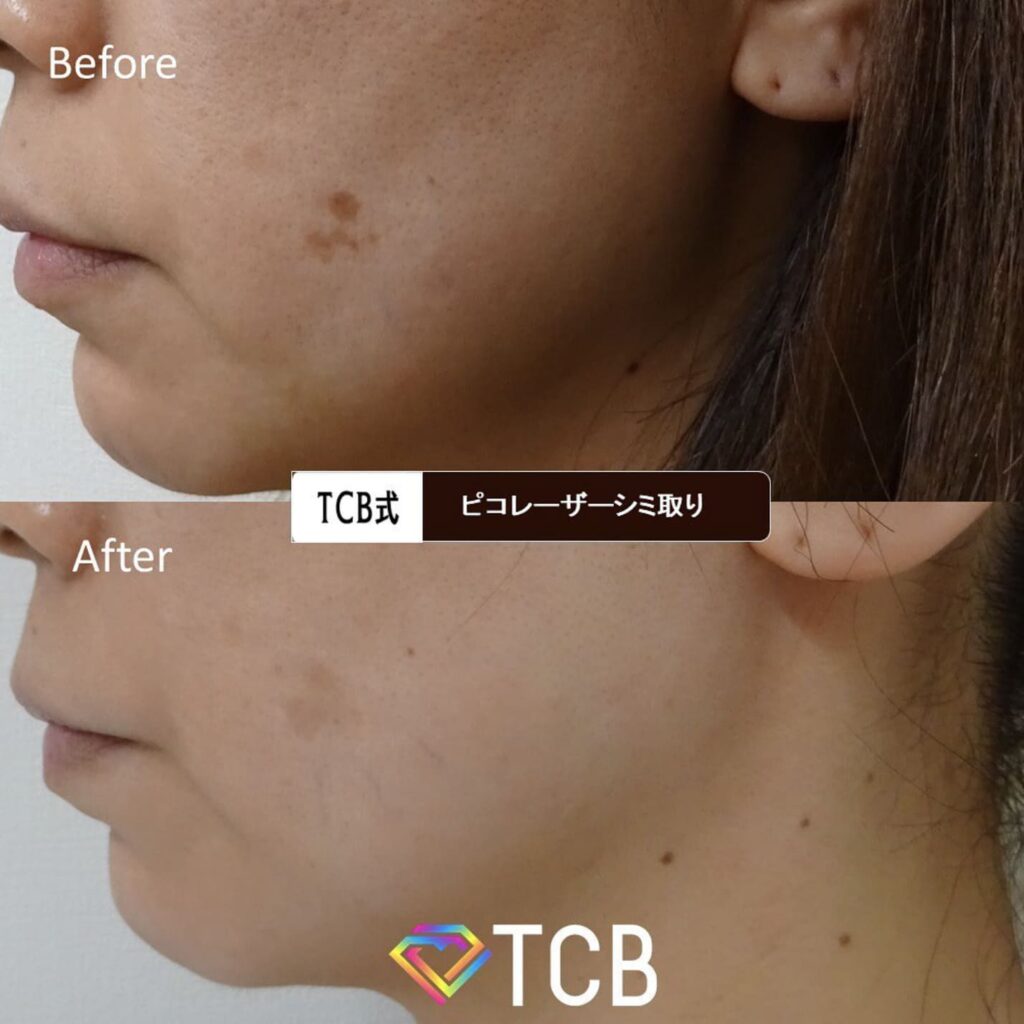 TCB東京中央美容外科で実際にシミ抜きを受けた方のビフォーアフター写真