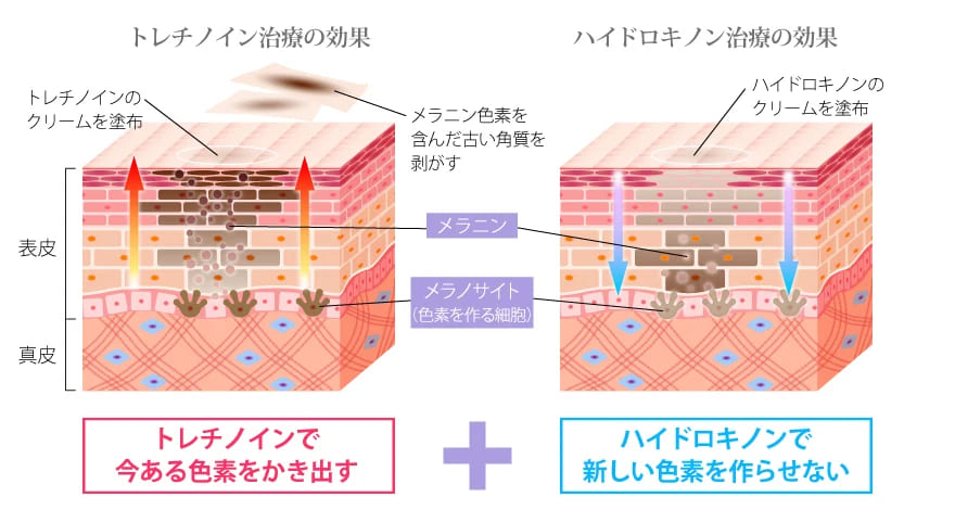 TCB東京中央美容外科の外用薬によるシミ取り治療で期待できる効果