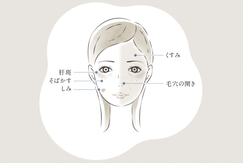 TCB東京中央美容外科のシミ取り治療で改善が期待できる症状