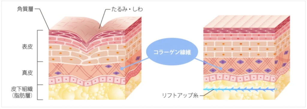 TCB東京中央美容外科の糸リフトのメカニズム