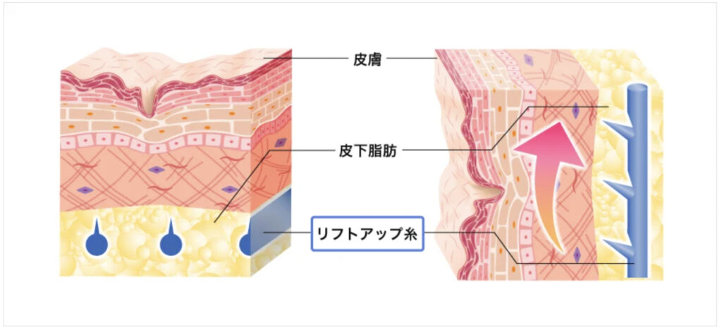 TCB東京中央美容外科の糸リフトで期待できる効果