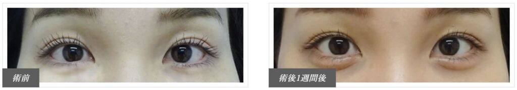 TCB東京中央美容外科で実際に涙袋形成を受けた患者さまの症例写真（ビフォー・アフター）