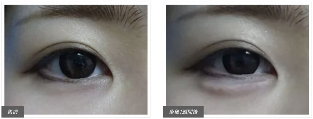 TCB東京中央美容外科で実際に涙袋形成を受けた患者さまの症例写真（ビフォー・アフター）