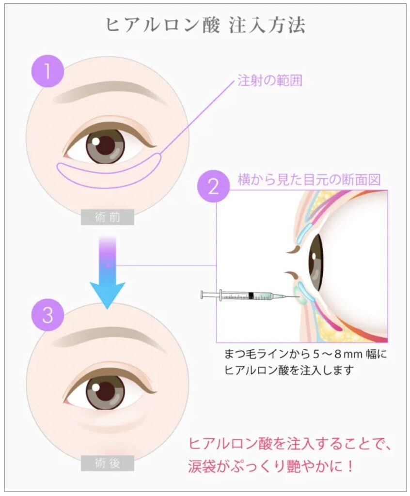 TCB東京中央美容外科の涙袋形成の施術の流れ