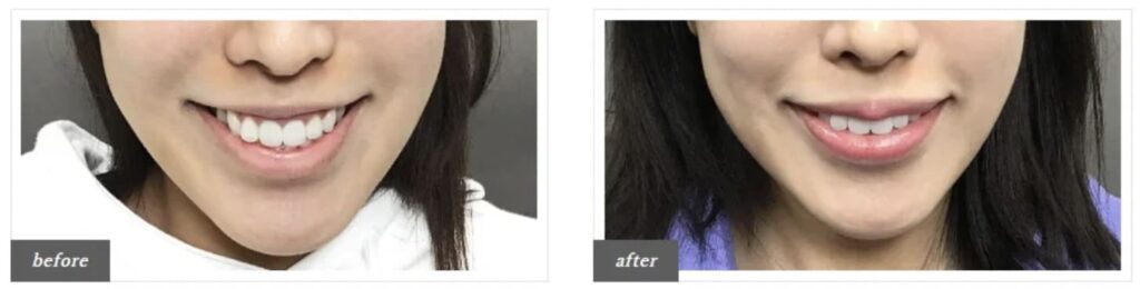 TCB東京中央美容外科で実際にガミースマイル治療を受けた患者さんの症例写真（ビフォーアフター）