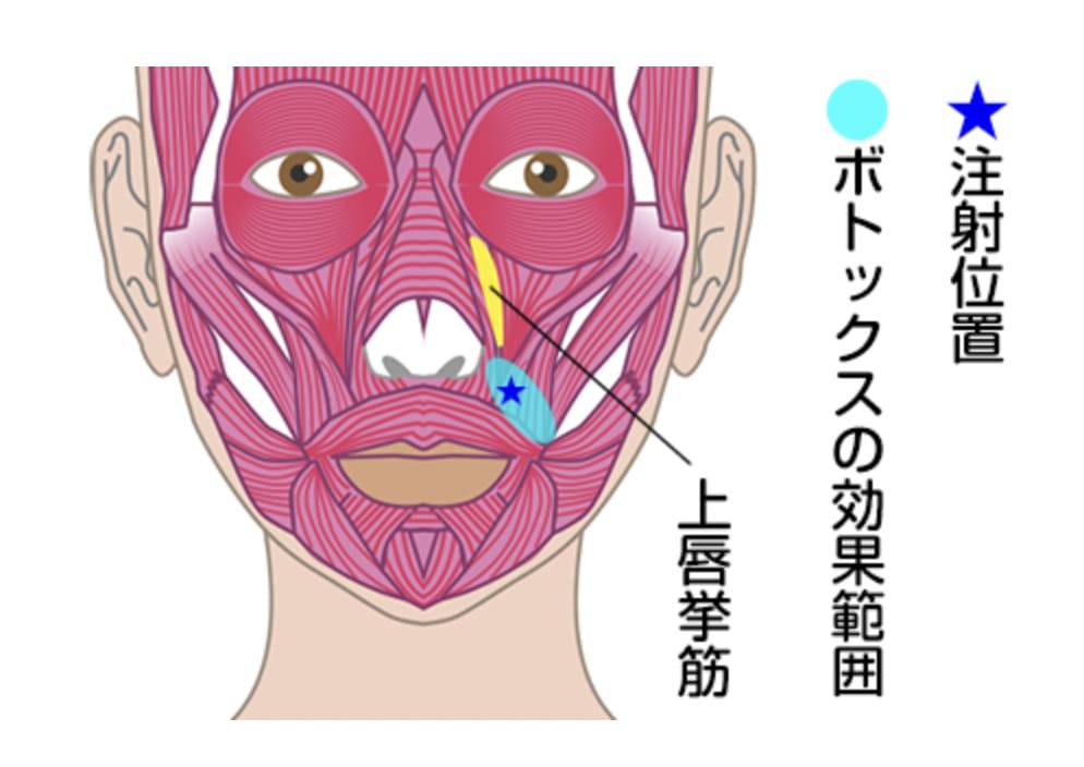 TCB東京中央美容外科のガミースマイル治療でボトックス注射を打つ部位（上唇挙筋）